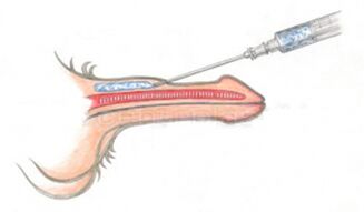 Tūrinė hialurono rūgšties injekcija į varpą